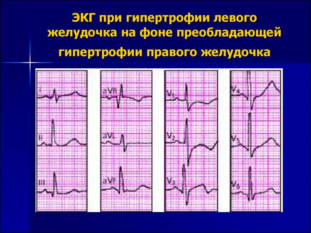 Неполная блокада правой ножки это опасно. Блокада ПНПГ И передней ветви ЛНПГ на ЭКГ. Блокада передней ветви правой ножки пучка Гиса на ЭКГ. Блокады ветвей пучка Гиса на ЭКГ. Полная правая блокада пучка Гиса на ЭКГ.