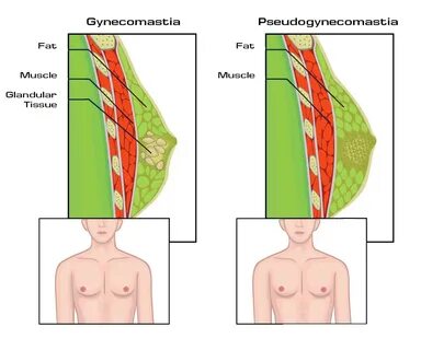 Pseudogynecomastia - Diagnosis and Treatment Options - Lose Man Boobs.