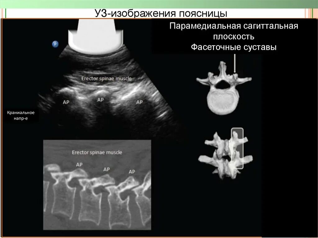 Фасеточная блокада. Блокада фасеточных суставов под УЗИ контролем. Ультразвуковое исследование позвоночника. Фасетки позвоночника на УЗИ.