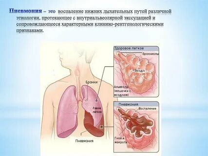 Воспаление верхних дыхательных путей