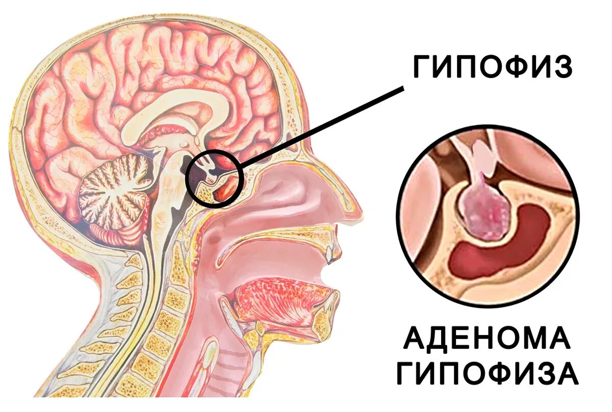 Аденоме отзывы врачей. Аденома гипофиза патология. Аденома гипофиза передней доли симптомы. Микроаденома головного мозга гипофиза микроаденома. Аденома гипофиза головного мозга что это такое.