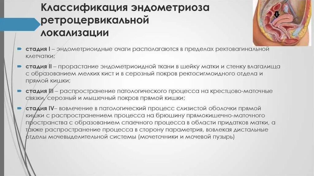 Классификация эндометриоза ретроцервикальной локализации. Эндометриоз классификация стадии ретроцервикальный. Классификация генитального эндометриоза. Классификация экстрагенитального эндометриоза. Маточное бесплодие