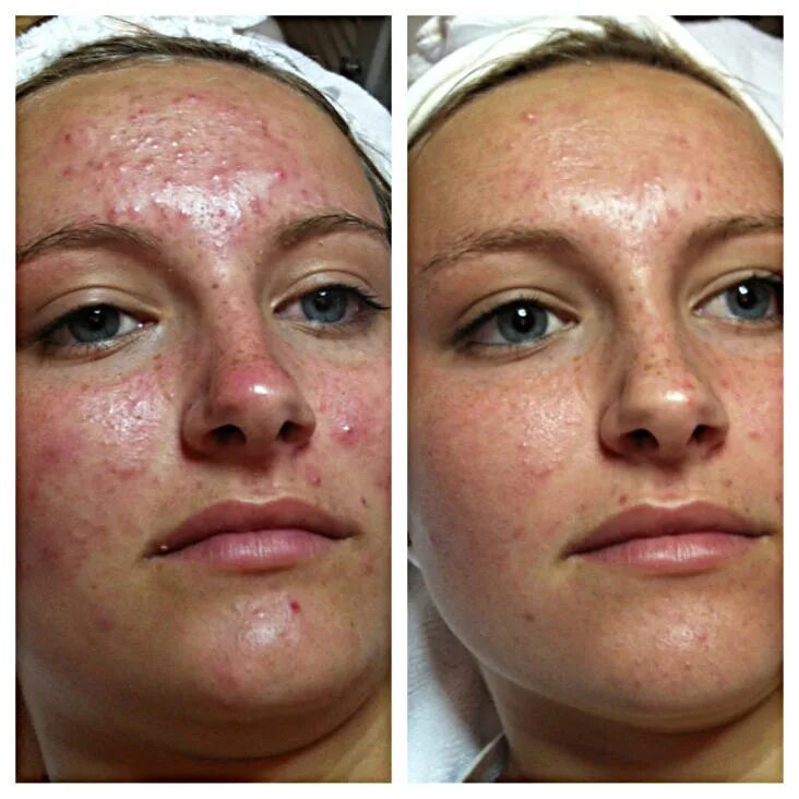 Чистка лица новое 2024. Пилинг Джесснера акне до и после. Криомассаж лица до и после. Кожа до и после косметолога. Кожа после чистки лица.