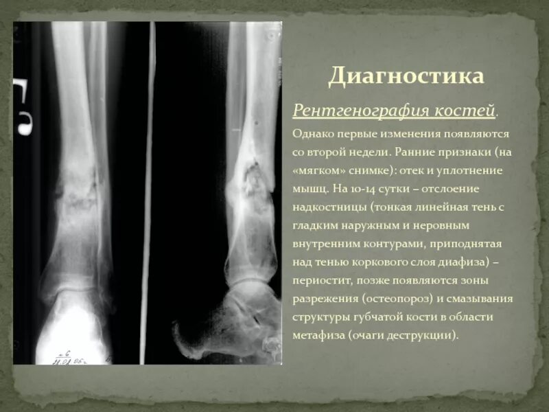 Ладьевидная кость стопы: лечение, причины болей