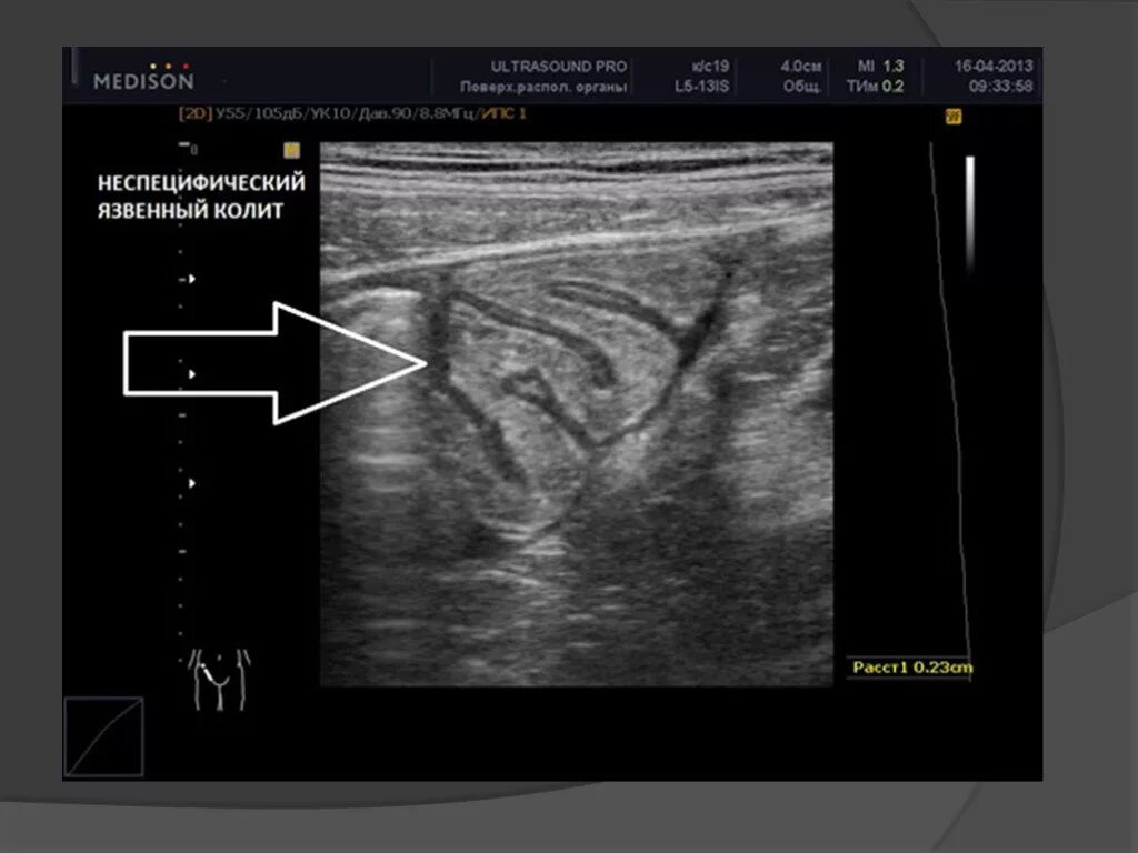 Инвагинация толстой кишки УЗИ. Неспецифический язвенный колит УЗИ. Кишечная непроходимость на УЗИ. Узи кишечника как подготовиться