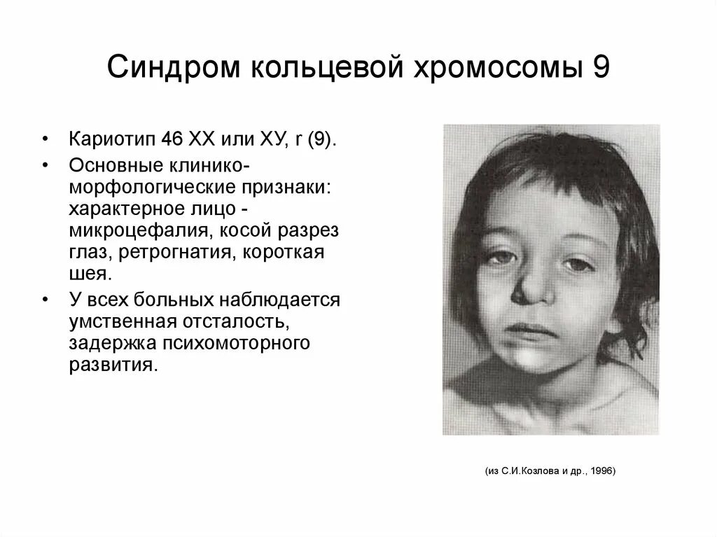 Синдром трисомии 9 хромосомы. Синдром трисомии по короткому плечу 9-й хромосомы. Трисомия короткого плеча 9 хромосомы. Синдром трисомия по х хромосоме кариотип. Кольцевая 4 хромосома