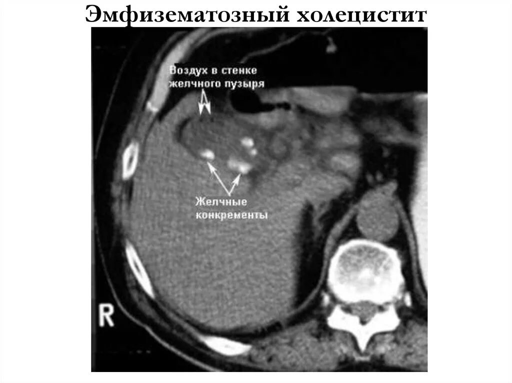 Камни на кт видны. Острый калькулезный холецистит на кт. Хронический калькулезный холецистит на кт. Абсцесс желчного пузыря кт. Конкременты желчного пузыря на кт.