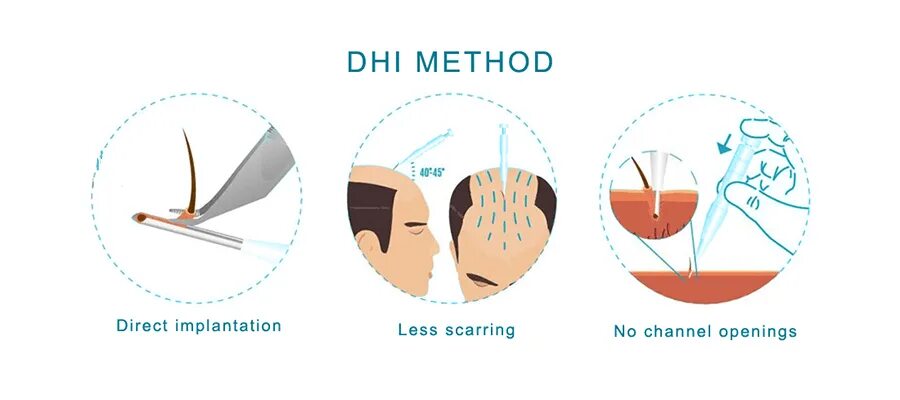 Dhi пересадка волос. Пересадка волос схема. Метод DHI пересадка волос. Пересадка волос иконки.