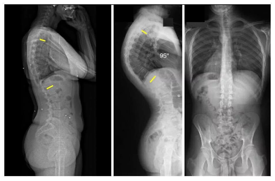 Болезнь Шейермана МАУ рентген. Болезнь Шермана МАУ рентген. Шермана МАУ позвоночника рентген. Изменение формы позвоночника
