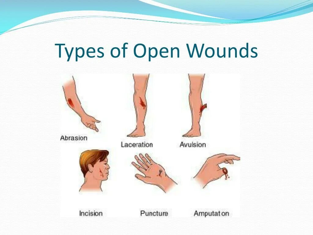 Types of wound. Types of wound