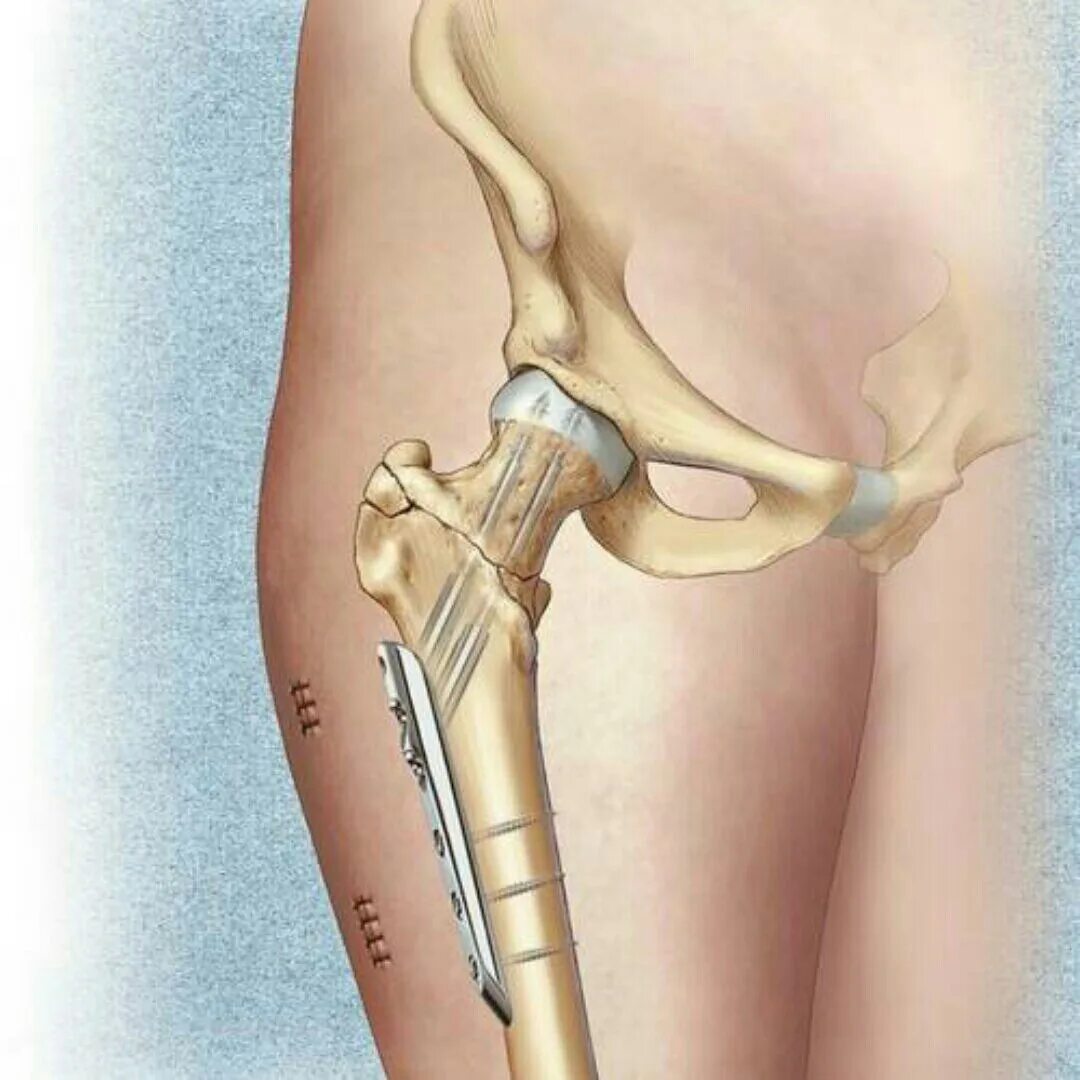 Болит бедро операция. Чрезвертельный перелом шейки бедра. Интрамедуллярный остеосинтез тазобедренного сустава. Перелом шейки бедренной кости. Перелом шейки бедра эндопротезирование тазобедренного сустава.