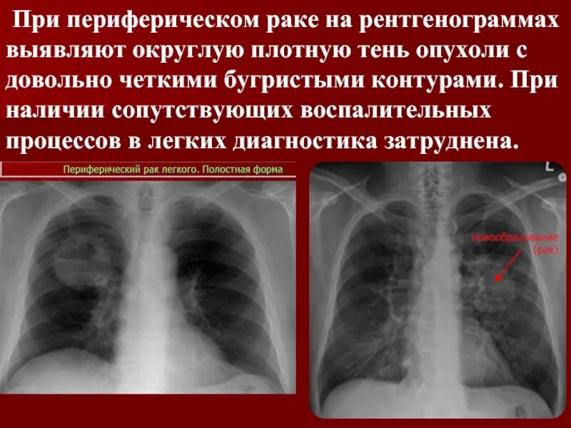 Периферические опухоли легких. Периферическая опухоль легкого. Округлых образования в лёгких. Образование в легких что это может быть