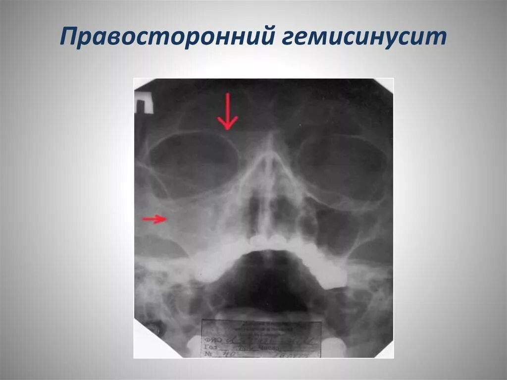 Правосторонний верхнечелюстной синусит. Правосторонний фронтит на рентгене. Гнойный гайморит рентген. Острый Гнойный гемисинусит. Правосторонний гнойный