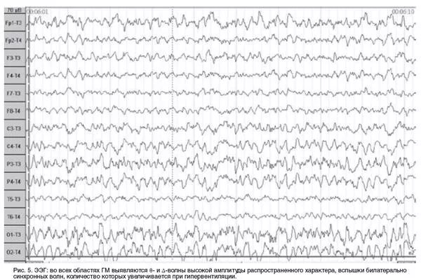 Легкие изменения бэа головного мозга. Биоэлектрическая активность головного мозга. Электрическая активность мозга при эпилепсии. Повышена биоэлектрическая активность лж.