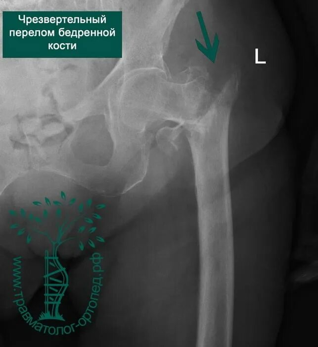 Чрезвертельный перелом шейки бедра рентген. Варусный перелом шейки бедра рентген. Межвертельный перелом бедренной кости рентген. Перелом шейки бедра со смещением. Шейки левого бедра