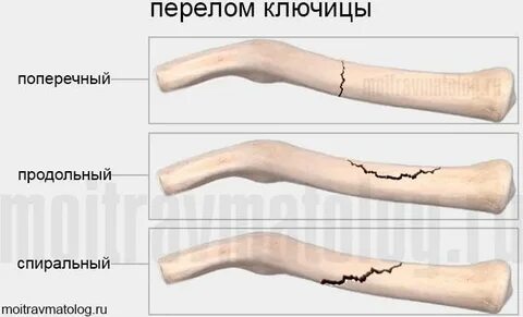 Ключица перелом сколько