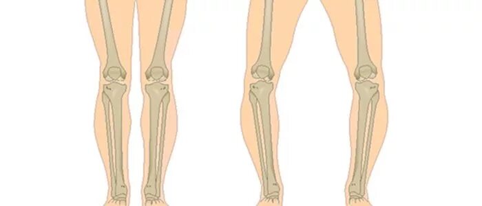 Варусная деформация деформация нижних конечностей. Вальгусная деформация коленных суставов. Варусная деформация ног у детей.