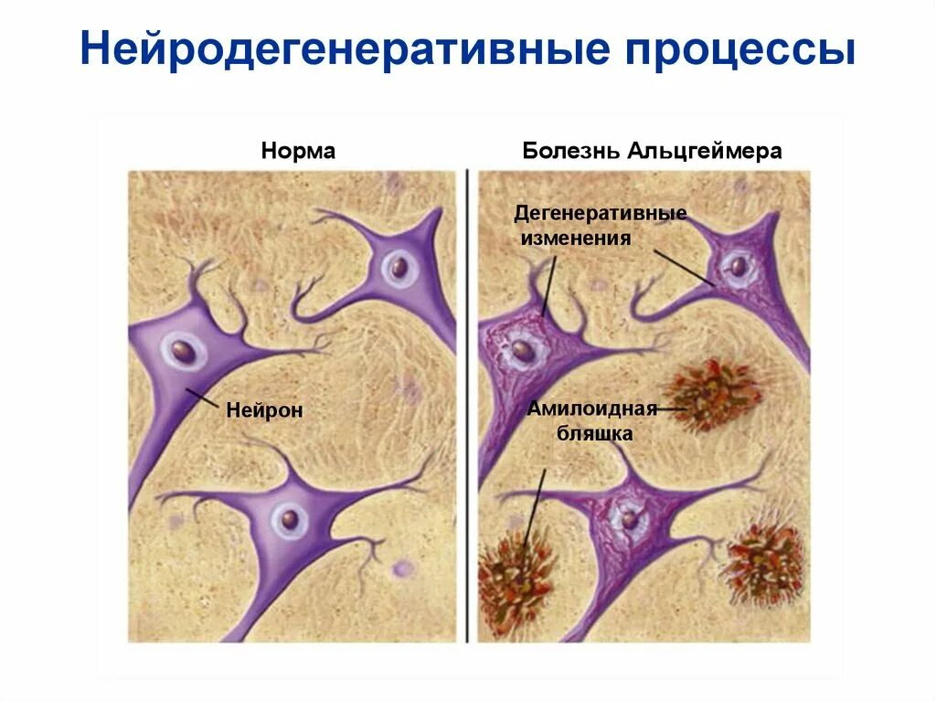 Нейродегенеративное заболевание головного. Болезнь Альцгеймера Нейроны. Нейродегенеративные процессы. Нейродегенеративные болезни. Старение нервных клеток.