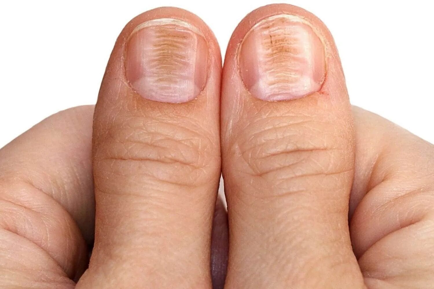 Ребристые ногти причина у мужчин. Ониходистрофия, лейконихия. Поперечные борозды бо-Рейли. Ониходистрофия - онихолизис..