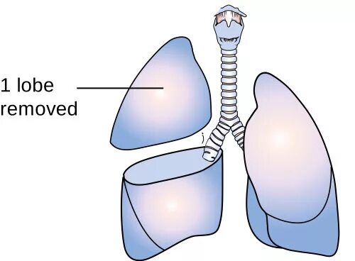 Хирургическая редукция объема легких. Почему уменьшается легкое