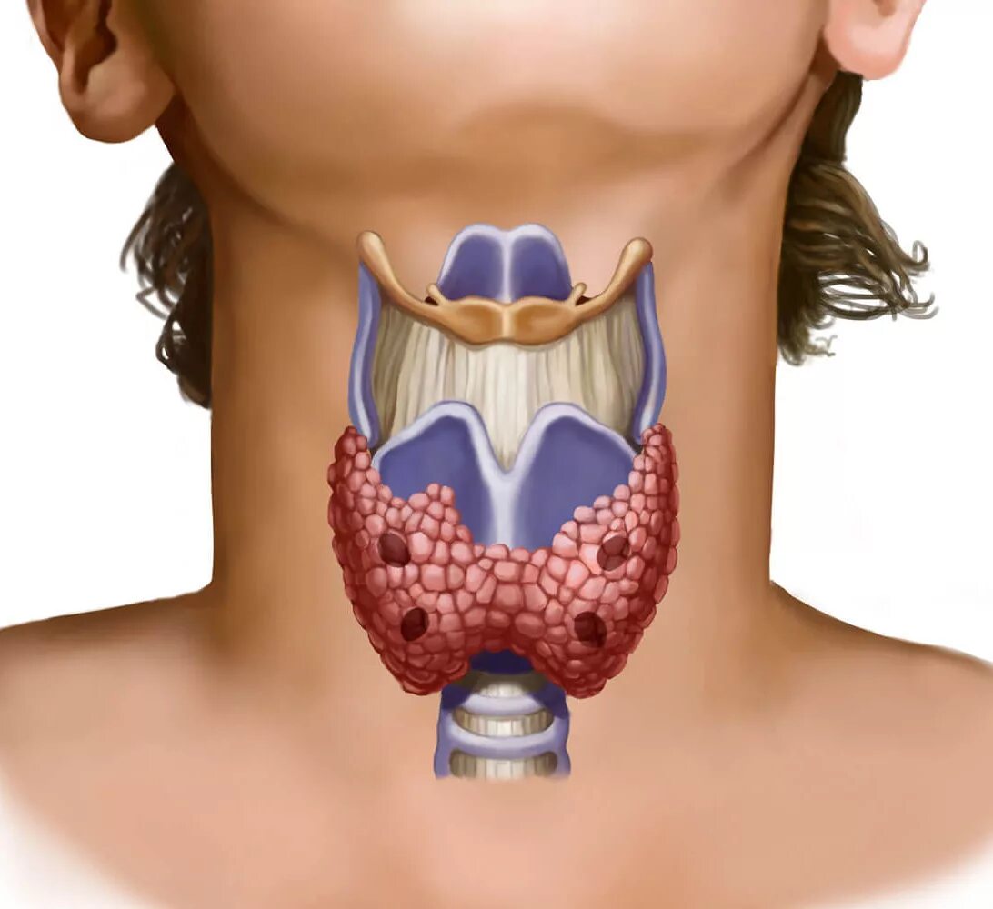 Узловой зоб щитовидной железы. Гемиагенезия щитовидной железы. Щитовидная железа перешеек щитовидной железы. Зоб ахан