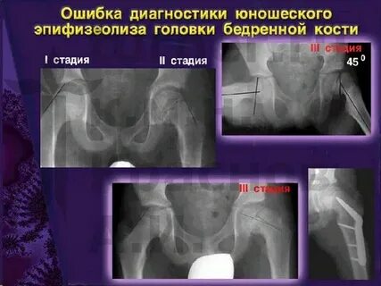 Эпифизеолиз код мкб