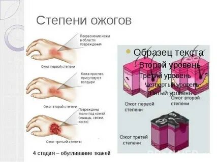 Степени ожогов таблица