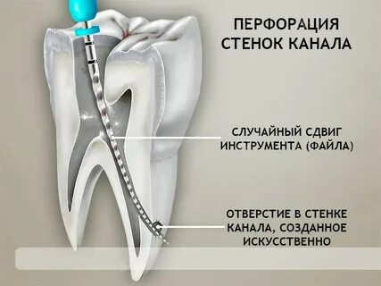 После лечения зуба болит зуб что делать