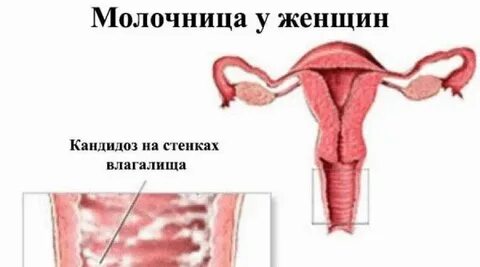 Клиническая молочница