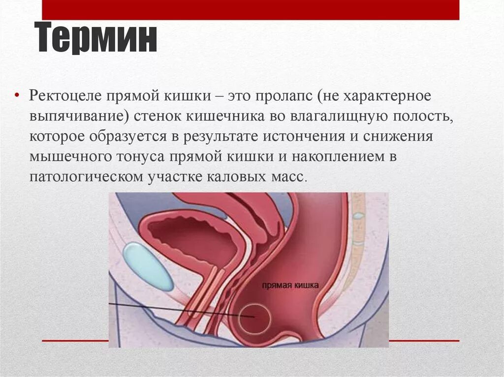 опущение и выпадение органов. пролапс стенок влагалища ректоцеле. операция при ректоцеле. цели оперативного лечения ректоцеле. проктология- ректоцеле.