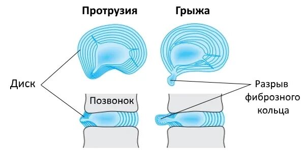 Что такое протрузия позвоночника и экструзия дисков. Разница протрузии и грыжи. протрузия и грыжа разница. протрузия экструзия грыжа. экструзии грыжи протрузии.