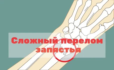 Внутренний и наружный перелом