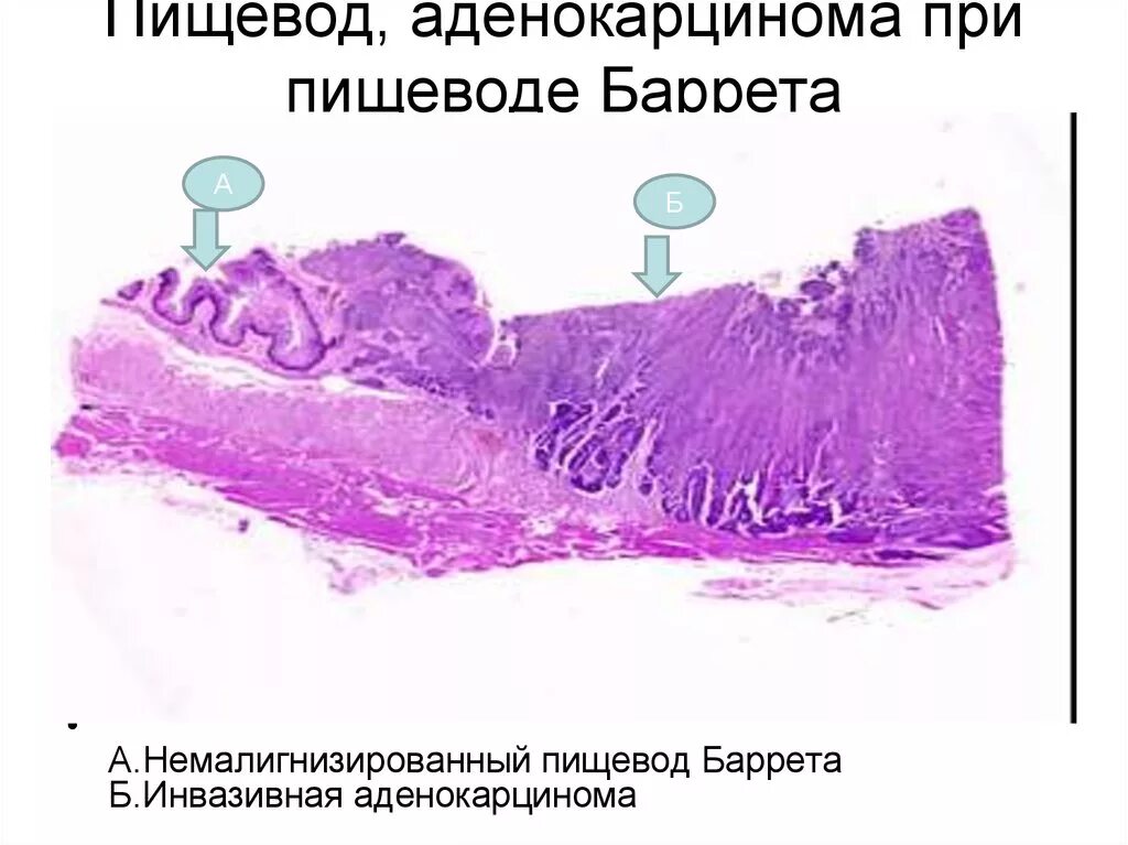 Пищевод Барретта гистология. Аденокарцинома пищевода. Аденокарцинома пищевода гистология. Пищевод Барретта аденокарцинома. Пищевод отзывы
