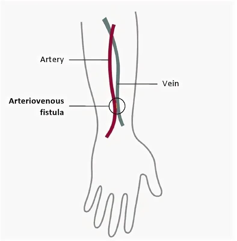 Фистула. Фистула гемодиализ схема.