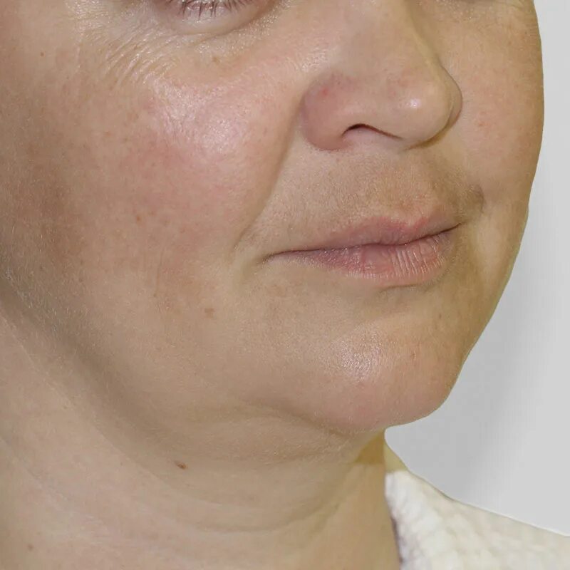 лазерный липолиз подбородка. лазерный липолиз подбородка. липосакция подбородка. липосакция подбородка. лазерный липолиз подбородка.