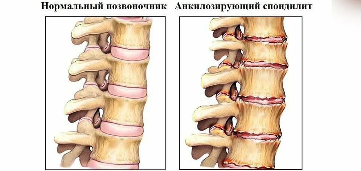 Артрит шейных позвонков. Шейный отдел позвоночника артрит. Шейный отдел позвоночника артрит. Ревматоидное поражение позвоночника. Дугоотросчатые суставы позвоночника рентген.
