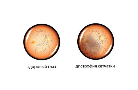 Дистрофия сетчатки улитки
