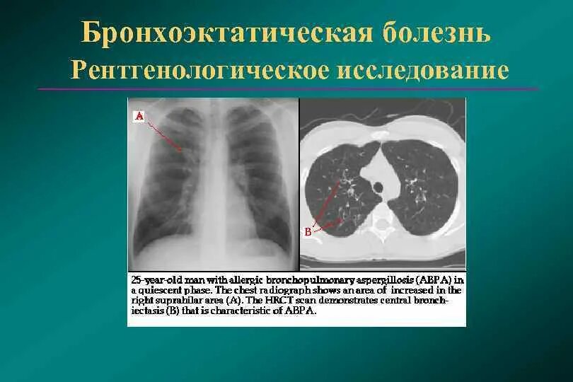 Цилиндрические и мешотчатые бронхоэктазы. Бронхоэктатическая болезнь (бронхоэктазы). Бронхоэктатическая болезнь (бронхоэктазы). Бронхоэктатической болезни легких. Бронхоэктатическая болезнь бронхография.