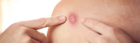 Peachtree Homeopathy clinic - Boils treatment in Pune 