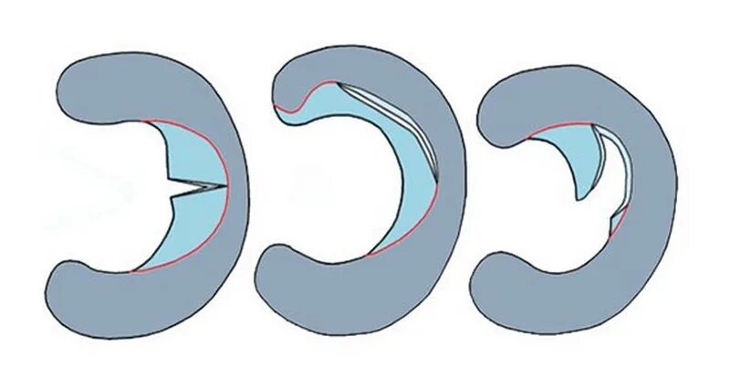Stoller 3b разрыв медиального мениска. Отрыв заднего рога медиального мениска. Повреждение заднего рога медиального мениска 3а. Дегенеративные изменения заднего рога медиального мениска 2