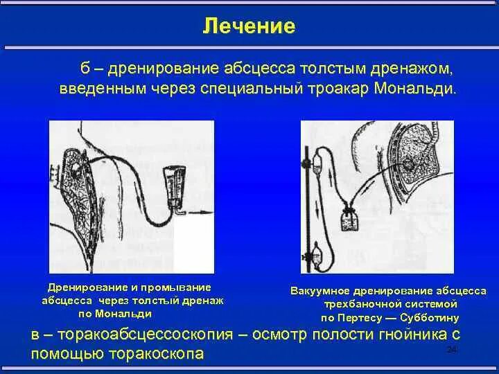 Что значит дренировать. Что значит дренировать