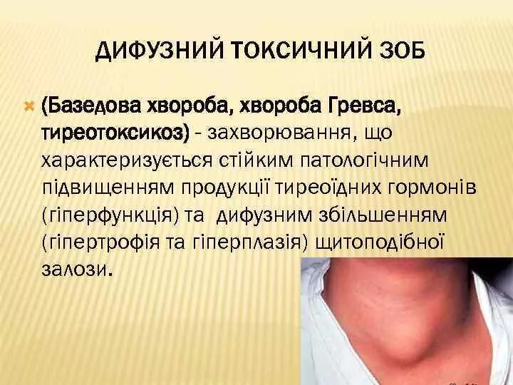 Зоб что это такое как лечить. Тиреотоксикоз с диффузным зобом.