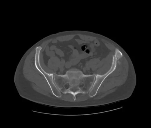Кт подвздошной кости. Фиброзная дисплазия подвздошной кости на кт. Деструкция подвздошной кости на кт. Метастазы в подвздошной кости кт. Киста подвздошной кости на кт.