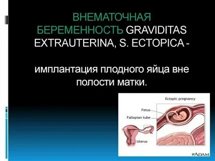 Внематочная беременность тема