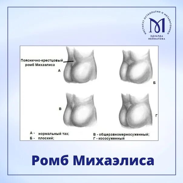 Пояснично крестцовый ромб михаэлиса норма. Формы ромба михаэлиса при узких тазах. Верхний угол ромба михаэлиса. Ромб михаэлиса. Ромб миахелися.
