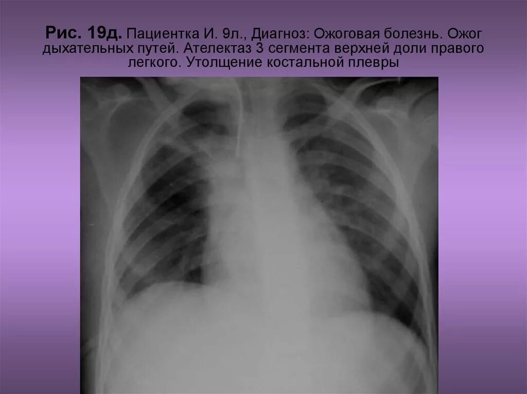 Химический ожог легких. Костальный плеврит рентген. ОДОН дыхательных путей. Костальная плевра на рентгене.