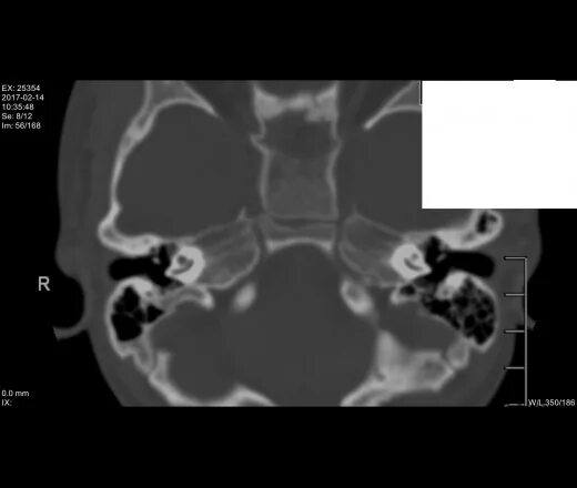 Камни на кт видны. Фенестральный отосклероз. Кохлеарный отосклероз на кт. Отосклероз уха на кт. Фенестральный отосклероз на кт.