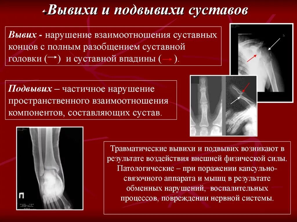 Вывих это повреждение. Рентгенологическая картина вывиха и подвывиха в суставе. рентген признаки вывиха. рентген вывиха симптомы.