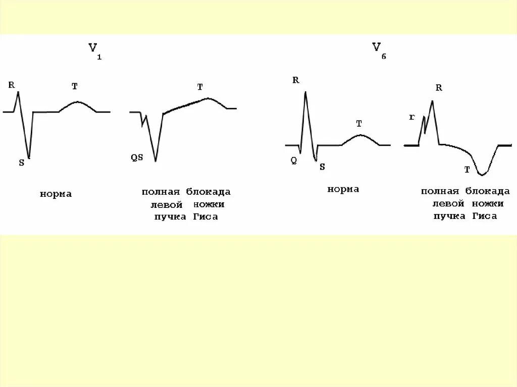 Что значит блокада левой ножки пучка гиса. Блокада левой ножки пучка Гиса (БЛНПГ. Полная блокада левой ножки пучка Гиса. Блокада правой и левой ножек пучка Гиса. Левая блокада ножки пучка Гиса.