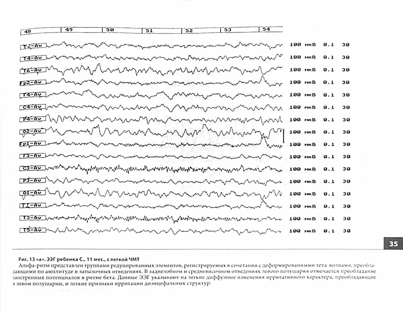 Нормы ээг у детей. Атлас ЭЭГ. Лямбда волны на ЭЭГ. Атлас ЭЭГ дети. Атлас электроэнцефалограмм.